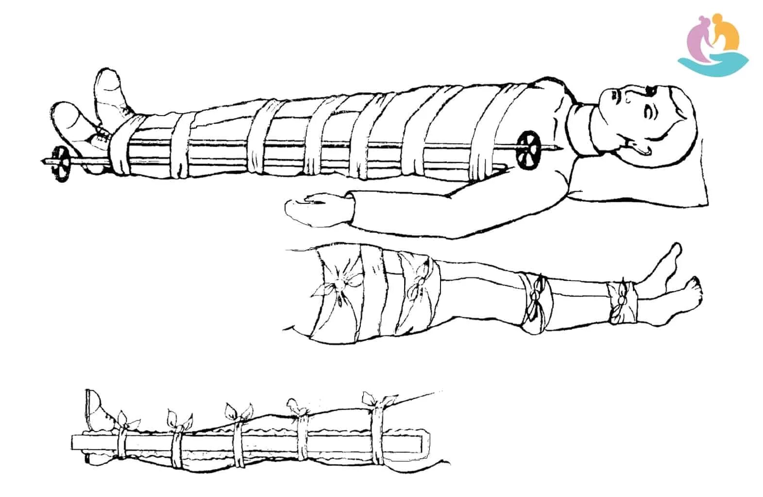 Перелом голени транспортировка. Транспортная иммобилизация конечности при переломе бедра. Перелом бедра транспортная иммобилизация. Перелом шейки бедра транспортная иммобилизация. Иммобилизация конечности при переломе шейки бедра.