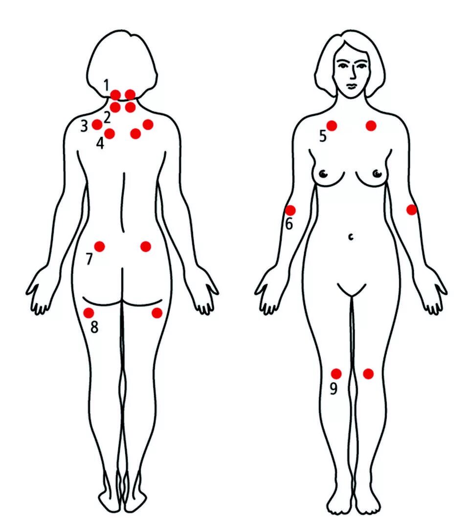 Фибромиалгия болевые точки. Болевые точки при фибромиалгии. Фибромиалгия триггерные точки. Фибромиалгия симптомы симптомы. Фибромиалгия симптомы причины и лечение