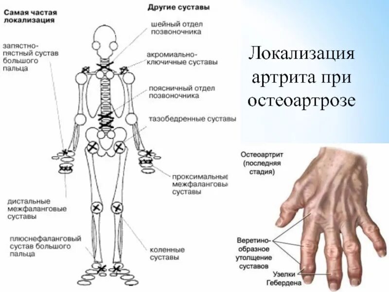 Схема поражения суставов при ревматоидном артрите. Схема суставов ревматоидный артрит. Название всех суставов человека. Локализация остеоартроза.