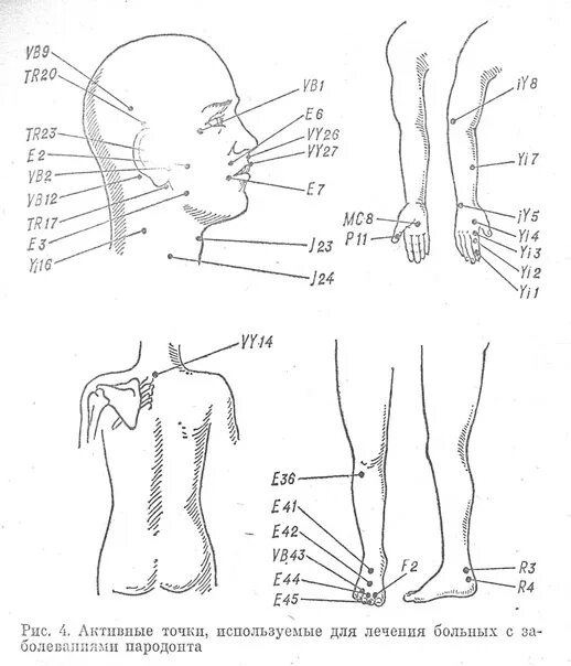 Иглоукалывание лицевой нерв. Точки акупунктуры при неврите лицевого нерва. Акупунктурные точки при параличе. Акупунктурные точки тройничного нерва. Иглоукалывание точки на теле схема.