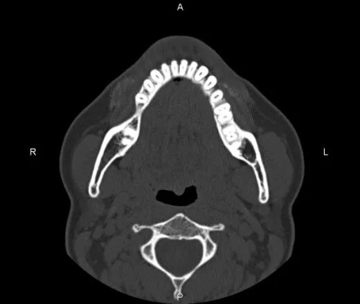Кт нижней челюсти цена в ульяновске. Остеомиелит челюсти компьютерная томография. Остеомиелит челюсти на кт нижней челюсти. Образования нижней челюсти на кт. Образования верхней челюсти кт.