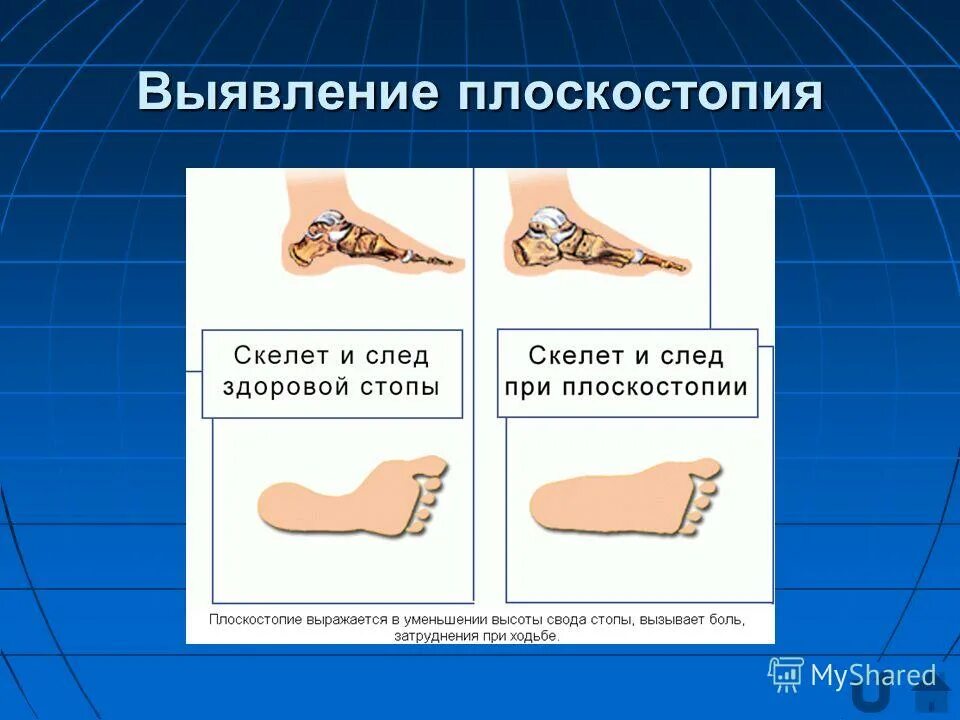 Определение плоскостопия по отпечатку. Выявление плоскостопия. скелет стопы плоскостопие. выявление наличия плоскостопия. способы выявления плоскостопия.