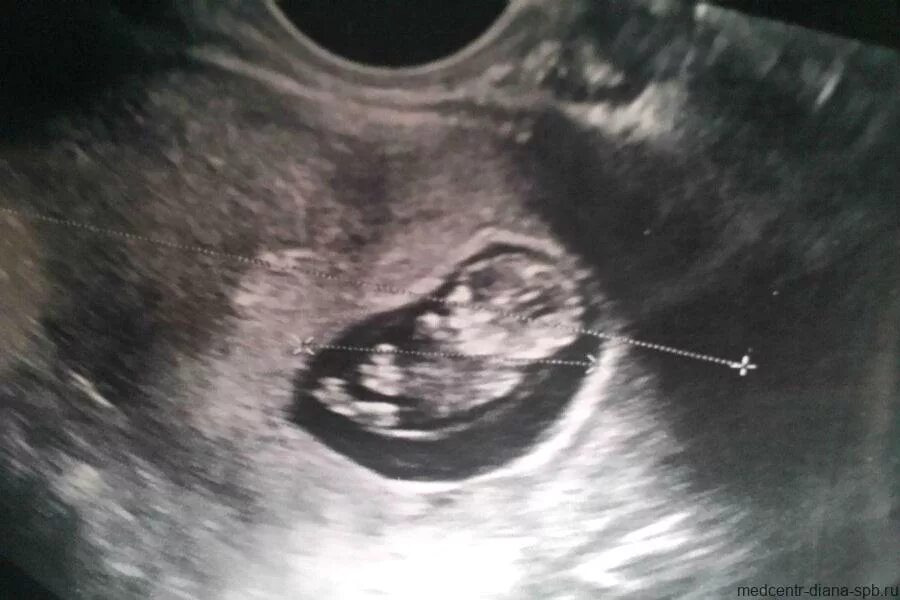 Stream 17.Anticonceptivos y aborto from ADORACION PROVIDA Listen online for free