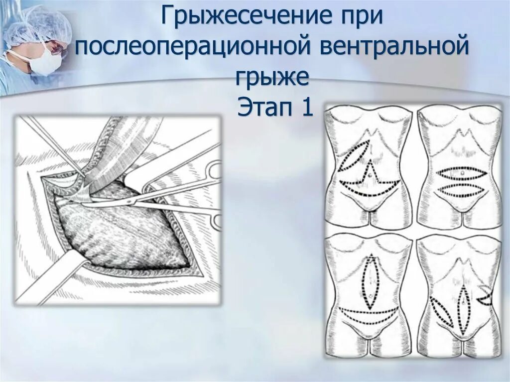 Операция пупочная грыжа шов. Вентральные послеоперационные грыжи живота. Операции грыжече грыжесечение. Вправление вентральной грыжи.