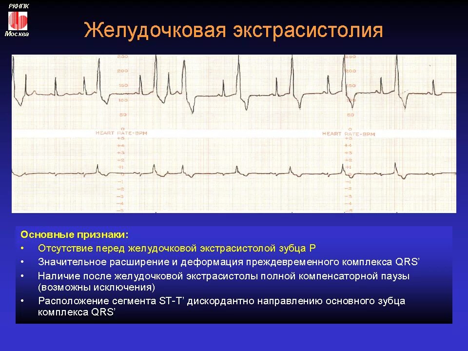 Сколько экстрасистол норма