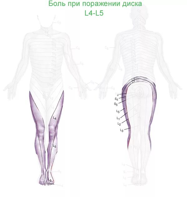 L4 l5 отдел позвоночника протрузия. Протрузия дисков позвоночника l4-5. Протрузии дисков l4-5 l5-s1 позвоночника. Протрузия l4-l5. Протрузия позвонков l4 l5.