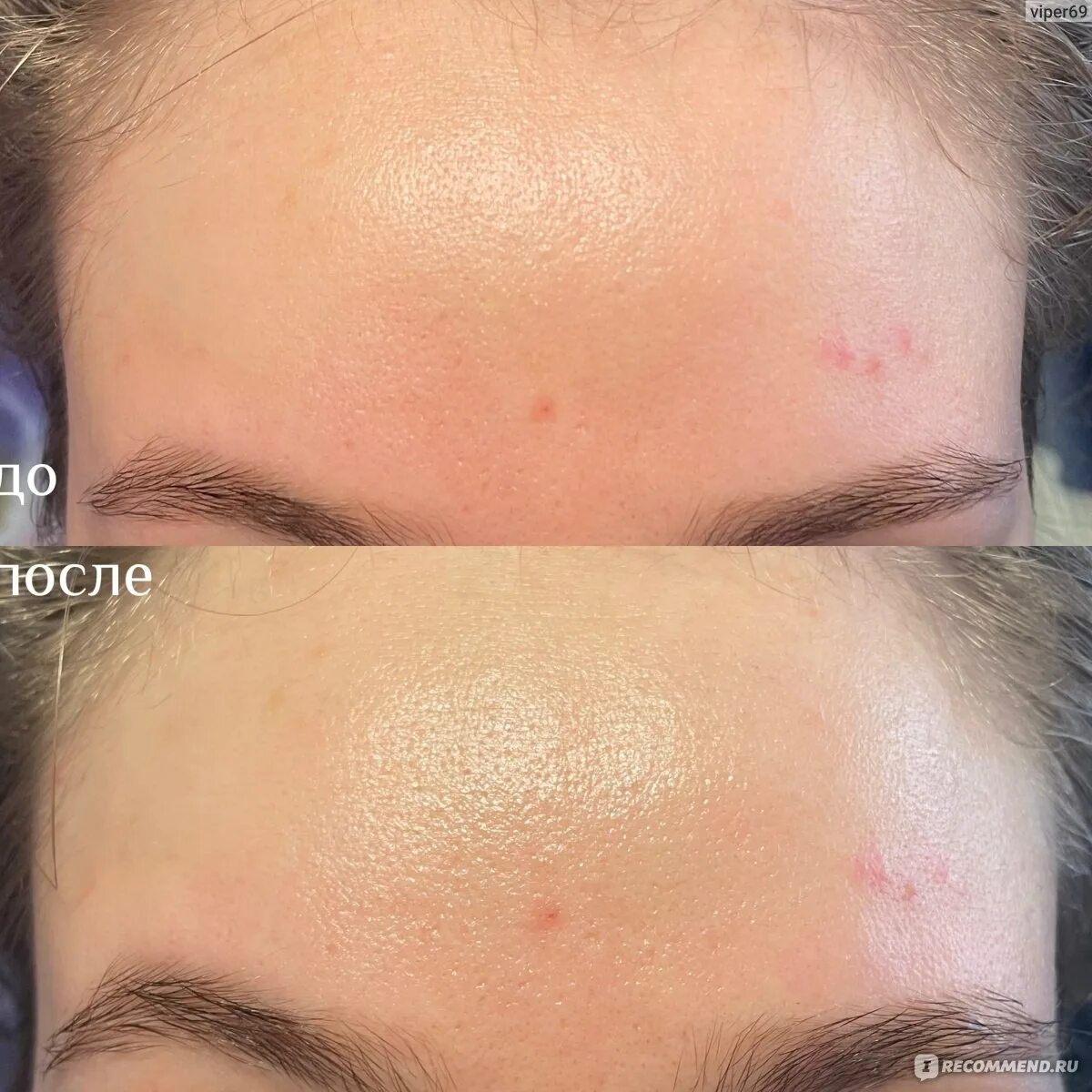 Neulii niacinamide 10. Neulii niacinamide 10