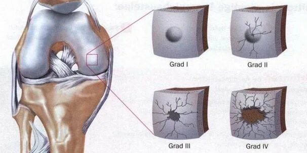 Хондромаляция мыщелка. Хондромаляция 2 степени коленного сустава. Хондромаляция надколенника 2. Хондромаляция надколенника Outerbridge. Хондромаляция 3 степени коленного сустава.