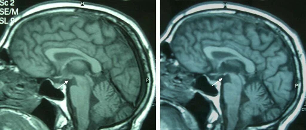 Резидуальная энцефалопатия мрт. Резидуально-органическое поражение головного мозга. Резидуальная энцефалопатия с внутричерепной гипертензией. Резидуально-органическая энцефалопатия симптомы. Хтэ болезнь