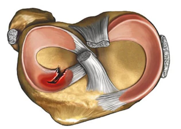 Поврежденный мениск коленного сустава. Разрыв мениска коленного. Мениск коленного сустава. Разрыв мениска коленного сустава. Колен Сустов разрыв мениск.