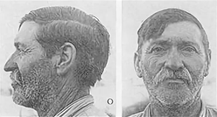 долихоцефалия. брахицефалия и долихоцефалия. долихоцефальная форма черепа. мезоцефалия антропология. долихоцефалия.