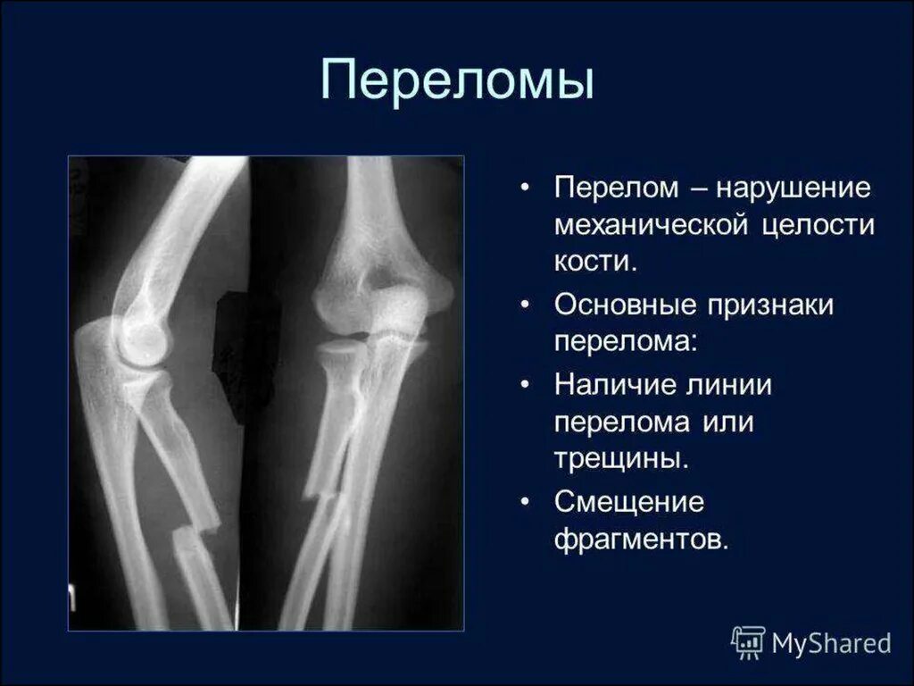 Продольный перелом лучевой кости. Рентген признаки перелома кости. Переломы костей рентгенограммы. Симптом перелома кости на рентгене. Симптомы перелома или трещины