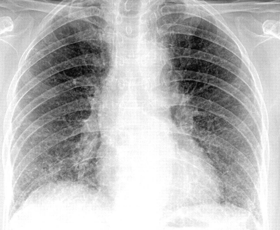 Интерстициальная пневмония рентген. Интерстициальная пневмония у детей рентген. Интерстициальная интерстициальная пневмония рентген. Интерстициальная пневмония снимки.