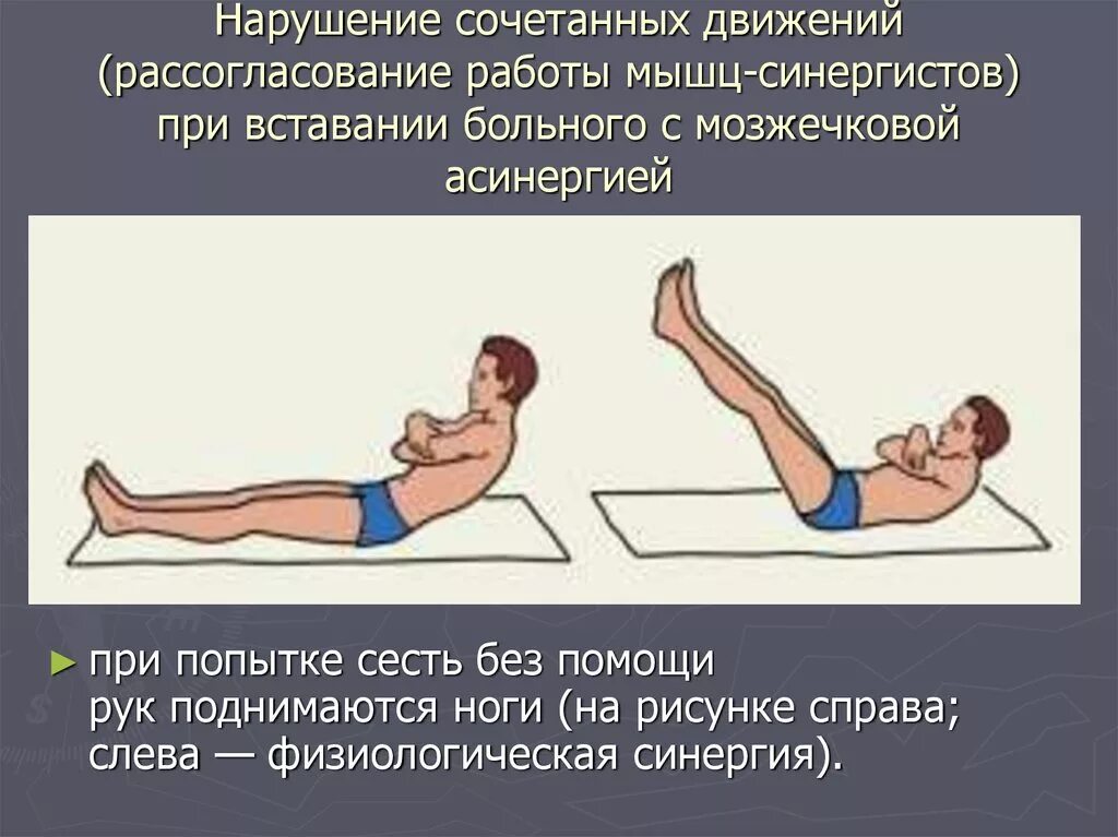 Что происходит при повреждении мозжечка. Асинергия бабинского. симптом асинергии бабинского. проба бабинского на асинергию. асинергия мозжечка.