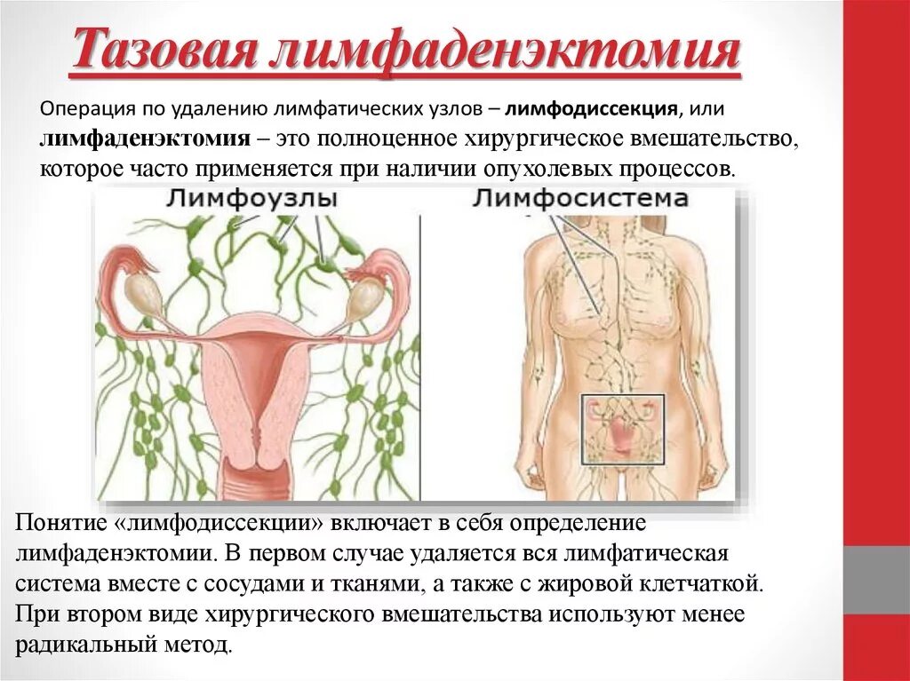 Тазовая лимфаденэктомия. Тазовая лимфодиссекция. Тазовые лимфатические узлы. Ягодичные лимфатические узлы. Лимфоузлы и удаление матки