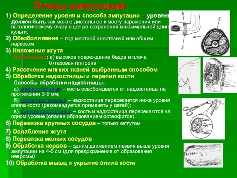 Уровни ампутации конечностей. Способы обработки кости при ампутации. Определение ампутации и экзартикуляции. Апериостальный способ.