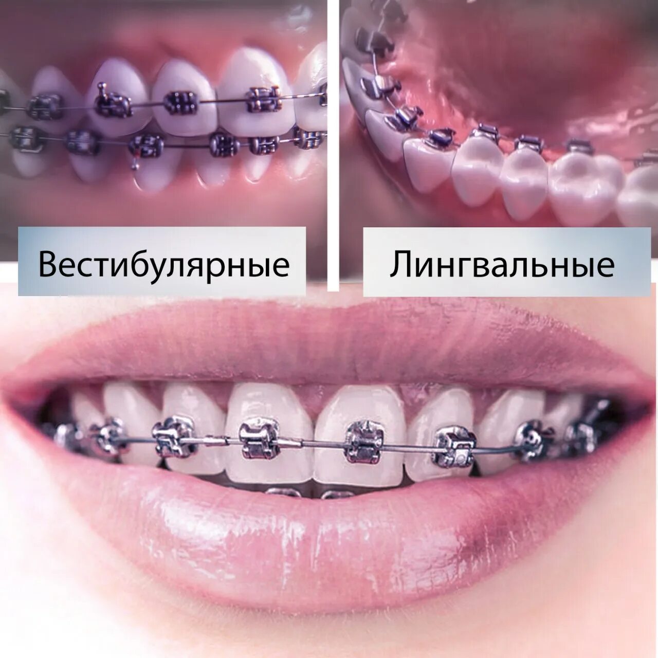 сколько стоят брекеты в тольятти. брекеты 2d forestadent (германия). сколько стоят брекеты в тольятти. брекеты мини мастер американ ортодонтикс. сколько стоят брекеты в тольятти.