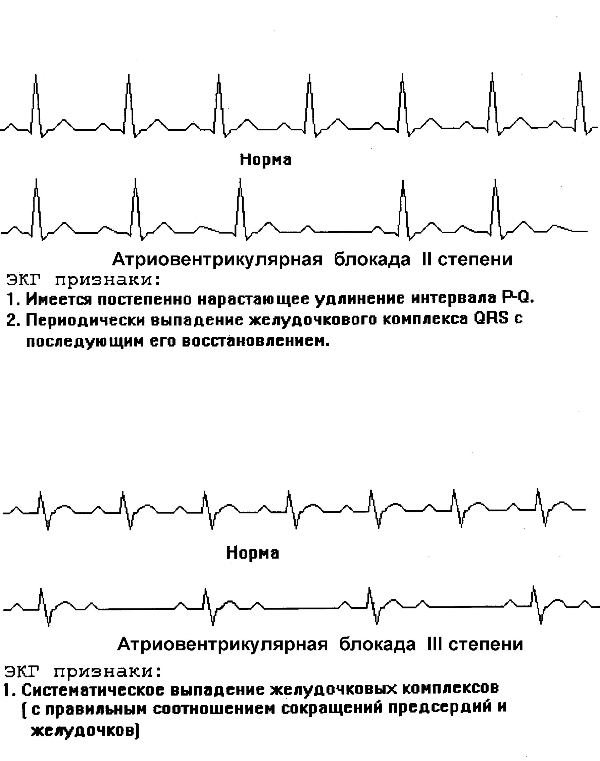 Атриовентрикулярная блокада признаки. Полная атриовентрикулярная блокада на ЭКГ. Полная атриовентрикулярная блокада 3 степени на ЭКГ. Полная АВ блокада 3 степени ЭКГ. Полная АВ блокада на ЭКГ признаки.