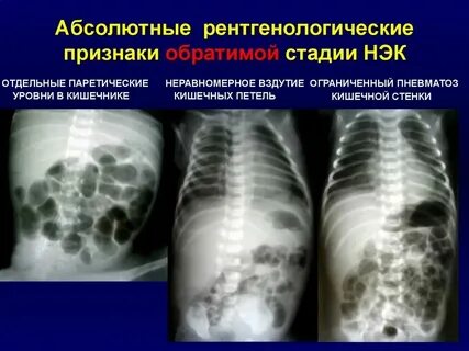 Что такое выраженный пневматоз
