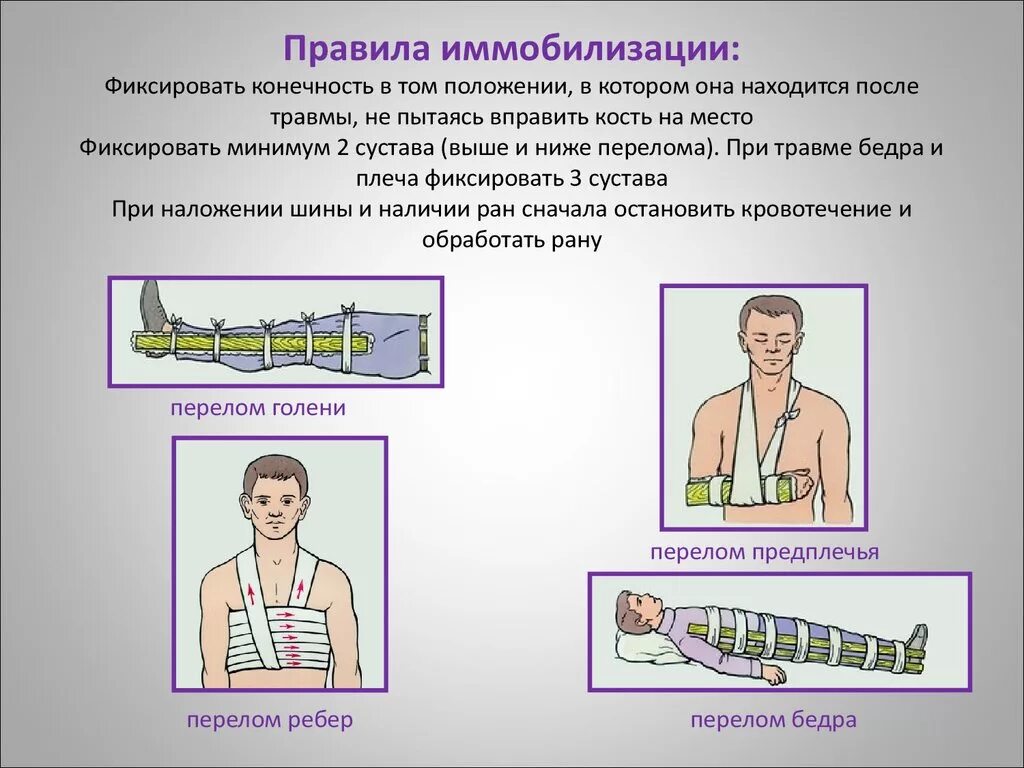 При переломе в первую очередь. Иммобилизация при переломе бедра ОБЖ. Основное правило иммобилизации при переломах костей конечностей.. Мобилизация конечности при переллмах. Иммобилизация при открытых переломах.