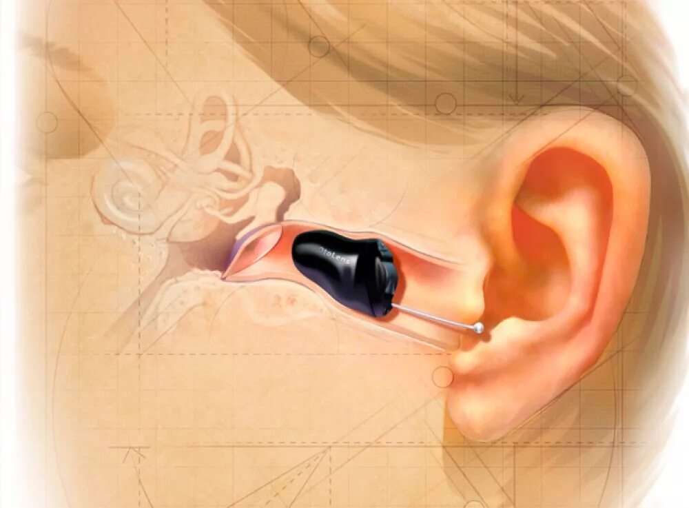 Глубококанальный слуховой аппарат. Слуховой аппарат внутриушной невидимый. Внутриканальный слуховой аппарат Phonak virto. Слуховой аппарат внутриканальный невидимый канал. Операция на ухо на слух
