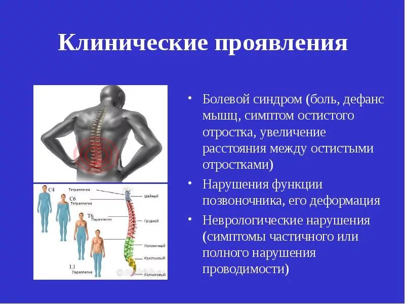 Дефанс мышц. Клинические симптомы повреждения спинного мозга. клинические проявления повреждений позвоночника. клинические проявления травм позвоночника. дефанс поясничных мышц.