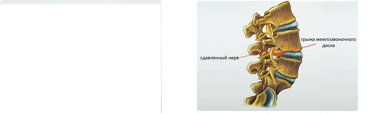 Грыжа как избежать