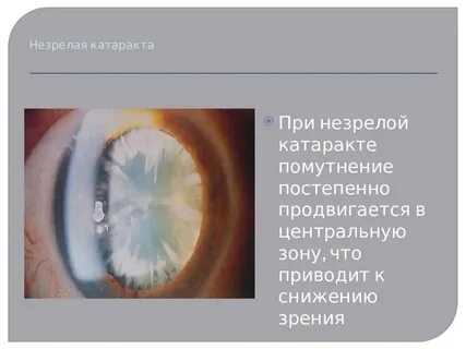Отзывы какой хрусталик при катаракте