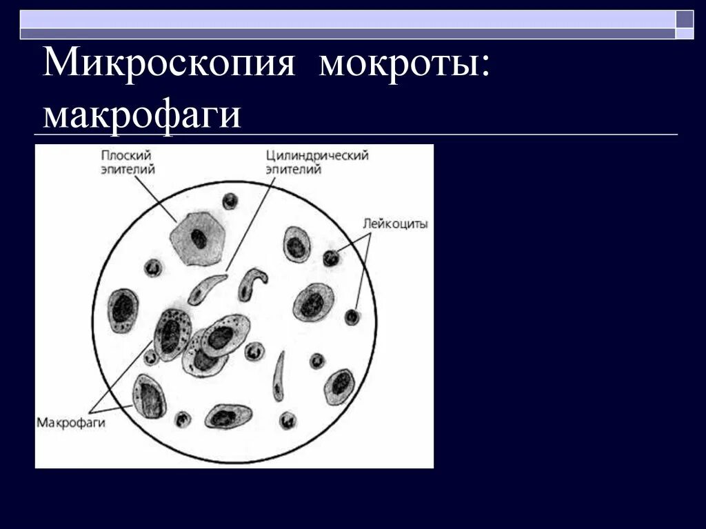 Элементы мокроты. Альвеолярные макрофаги в мокроте микроскопия. Мокрота нативный препарат микроскопия. Эпителий в мокроте микроскопия. Микроскопическое исследование нативного препарата мокроты.