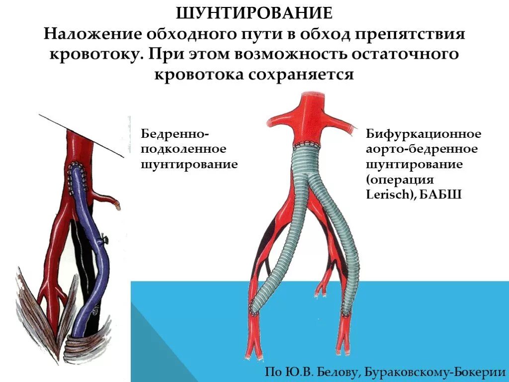 Операция шунтирование нижних. Бифуркационное аорто-бедренное шунтирование ход операции. Бедренно подколенное шунтирование техника операции этапы. Схема аортобедренного шунтирования. Аорто бедренная и подколенная шунтирование.