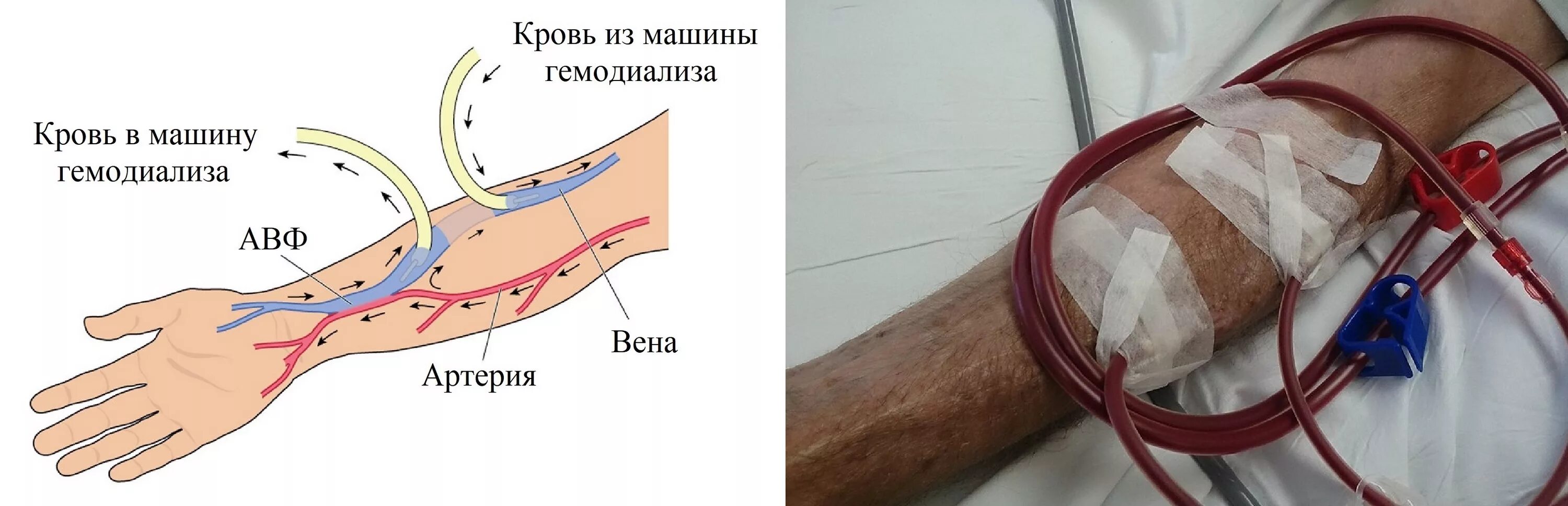 Почему после катетера. Артериовенозный шунт для гемодиализа. Артериовенозная фистула для гемодиализа. Артерия венозная фистула. Артерио-венозная фистула для гемодиализа.