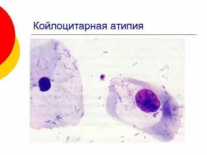 Атипия клеток что это