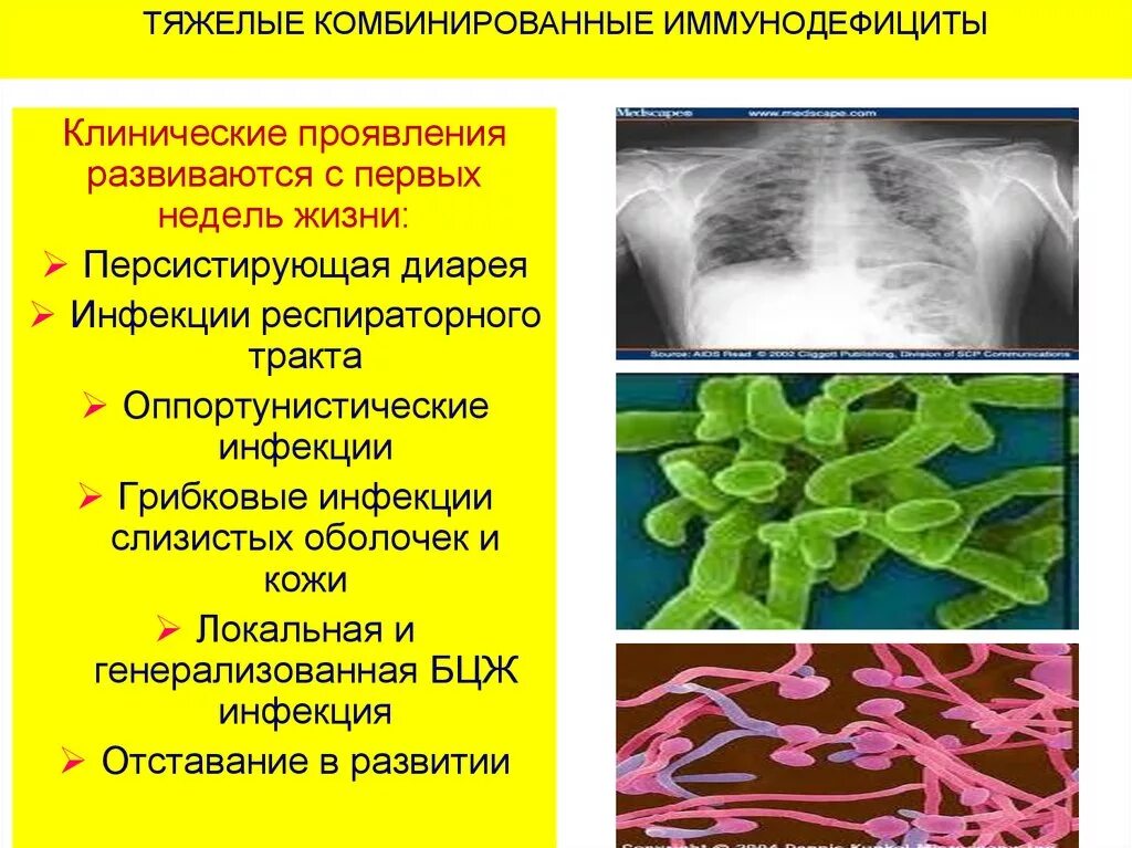 Тяжелый комбинированный иммунодефицит scid. Клинические проявления первичных иммунодефицитов. Комбинированная иммунная недостаточность. Тяжелые комбинированные иммунодефициты (ТКИД).