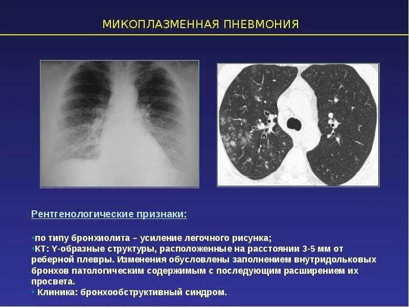 Болезни легких у детей. Рентгенологическая картина микоплазменной пневмонии. Рентген при микоплазменной пневмонии. Симптомы микоплазменной пневмонии. Микоплазма пневмонии Mycoplasma pneumoniae.