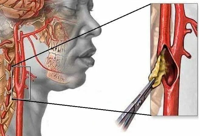 Сужение шейных сосудов. Атеросклероз сосудов бца. Стенозирующий атеросклероз БЦС. Атеросклероз сосудов БЦС. Атеросклероз внечерепных отделов брахиоцефальных артерий.