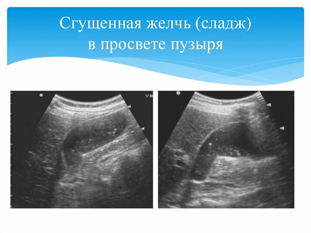 Заболевания желчного пузыря и желчевыводящих путей. Желчь реакция среды. Желчь. Печень и желчный пузырь. Желчь в желудке причины.
