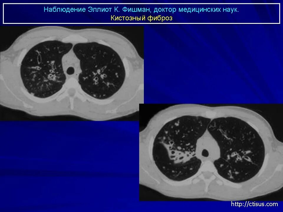 Кистозный фиброз легких кт.