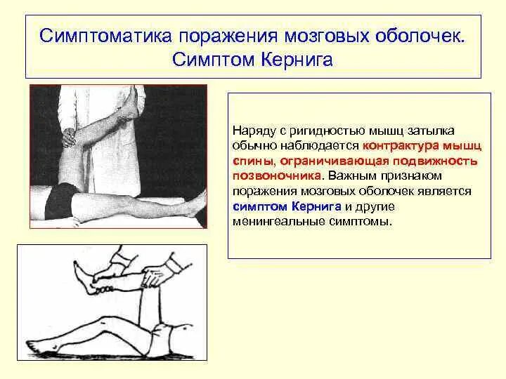 Поражение оболочек мозга. Симптомы поражения мозговых оболочек. Симптом ригидности затылочных мышц. Симптом Кернига при менингите.