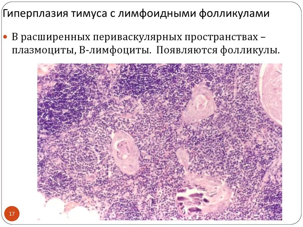 Лимфоузлы гиперплазированы. Акцидентальная инволюция тимуса микропрепарат. Гиперплазия лимфоидной фолликулов. Гиперплазия тимуса с лимфоидными фолликулами. Акцидентальная инволюция тимуса гистология.