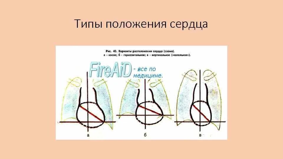 Горизонтальное положение сердца что это. Косое положение сердца. положение сердца в зависимости от типа телосложения. типы положения сердца. варианты расположения сердца.