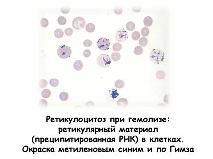 Ретикулоцитоз