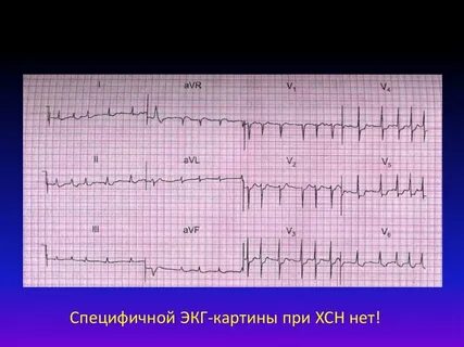 Экг недостаточность