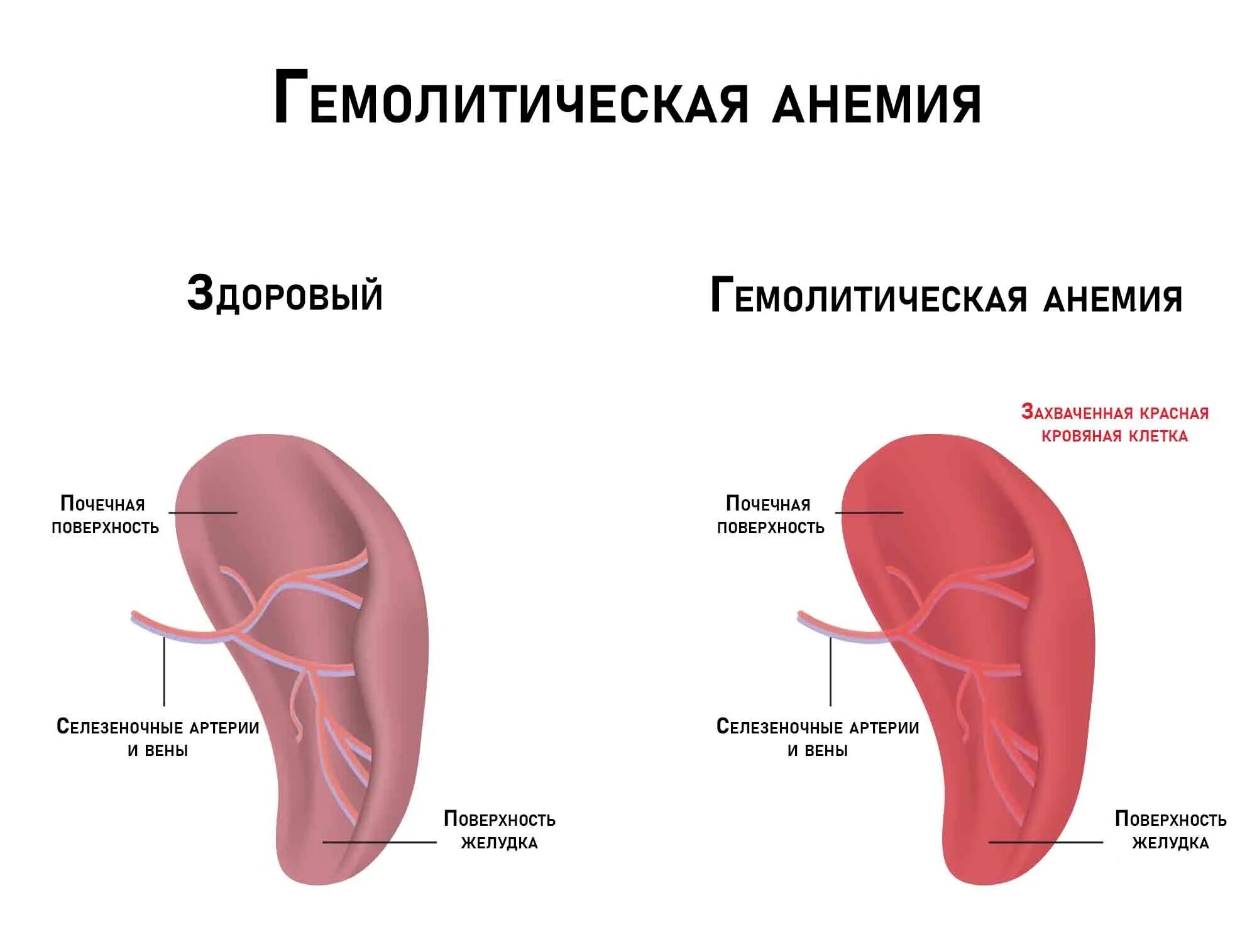 Боли печени и селезенки. Болезненность селезенки. Селезёнка болит симптомы.