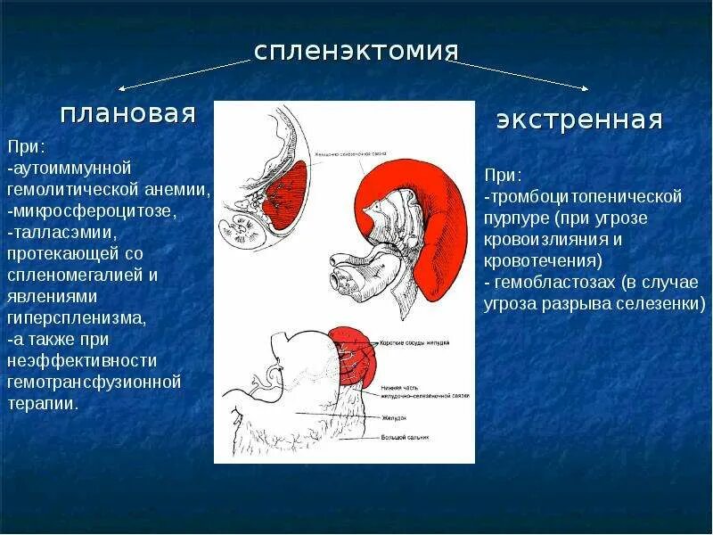 Спленэктомия что это. Этапы операции спленэктомии. Спленэктомия операция.