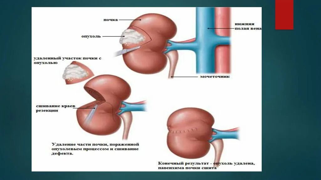 Резекция почки что это. Открытая резекция почки.