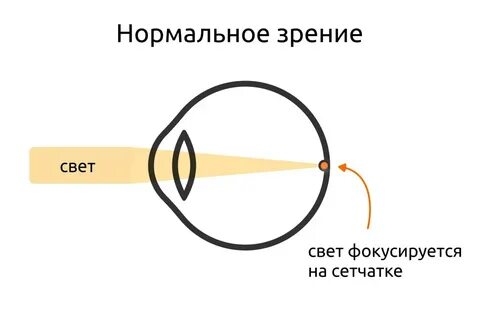 Анизометропией коррекция