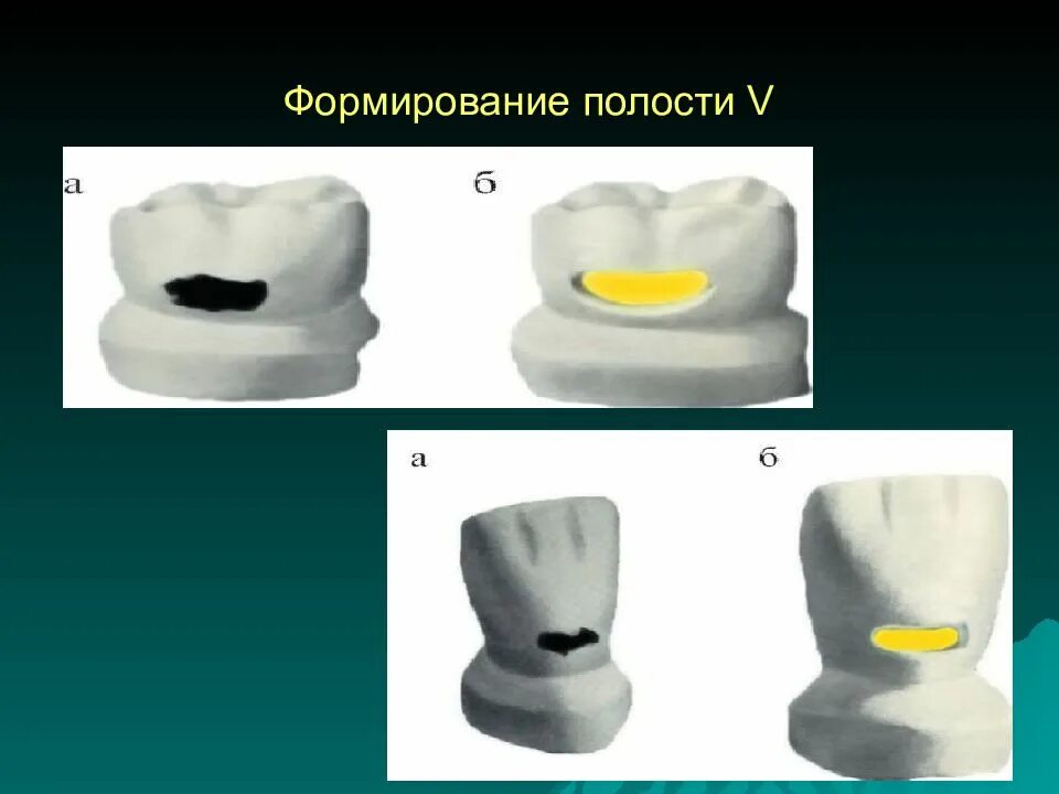 Пломбирование полостей по блэку. Кариозная полость 5 класса по блэку. кариозные полости v класса по блэку. формирование кариозной полости по 5 классу блэка. препарирование 1 и 2 класса по блэку.