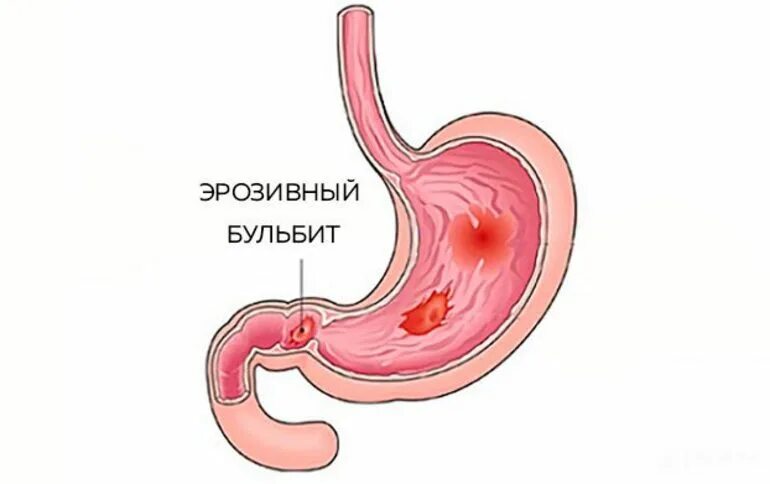 Что такое дуоденит желудка. Что такое дуоденит желудка