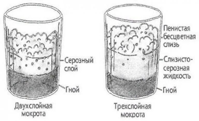 Мокрота пенистого характера. Бронхоэктатическая болезнь анализ мокроты. Исследование мокроты при бронхоэктатической болезни. Слои мокроты при бронхоэктатической болезни. Мокроты при бронхоэктатической болезни трехслойная.