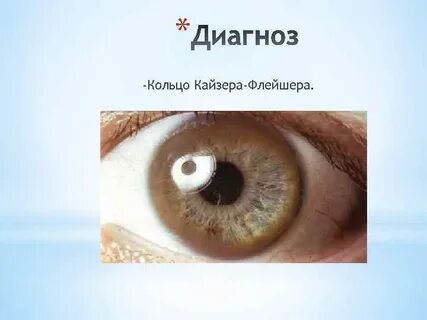 Кольца кайзера